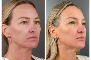 Client Case Study: Filler Rejuvenation for Volume Loss