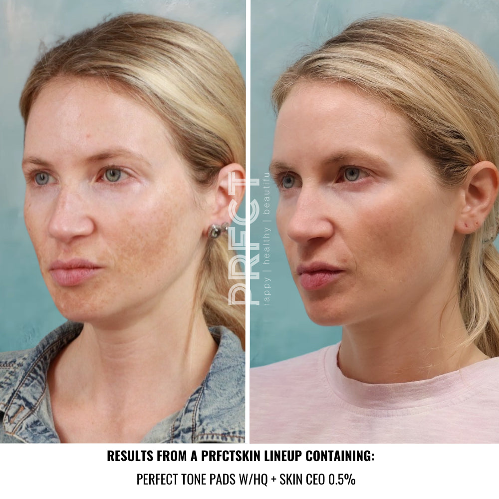 Perfect Tone Pads: Discoloration Fading + Brightening Pads with Kojic Acid | Alpha-Arbutin | Optional Hydroquinone