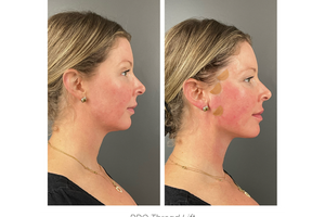 The Post-Weight Loss Glow-Up Guide: Improving Sagging Skin & Facial Hollowing
