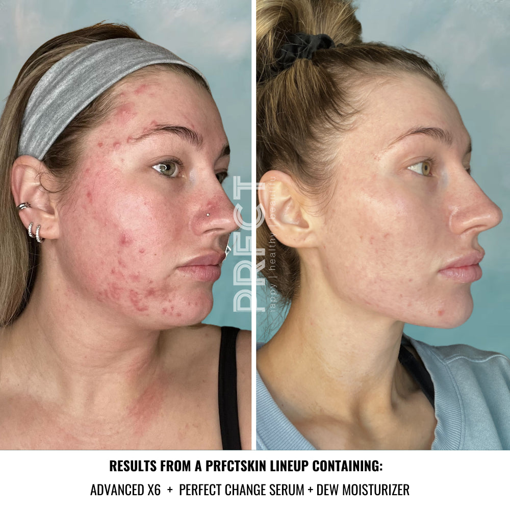Get Clear Acne Lineup