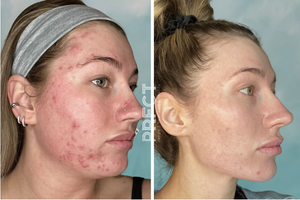 No Treatments, No Filters: Just PRFCTSKIN Results