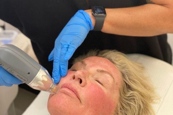 Radiofrequency Microneedling - Voted 'Best Med Spa' in San Diego | La Jolla Featured Image