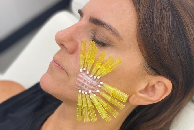 Collagen-Boosting Threads for Skin Rejuvenation in San Diego Featured Image
