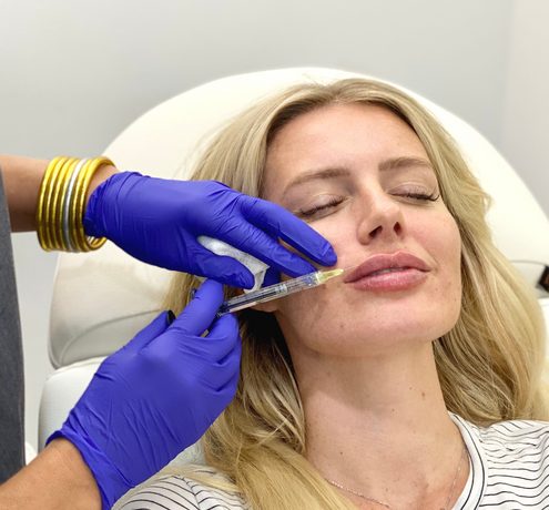 The Lip Guide—Featuring Lip Filler Before and Afters