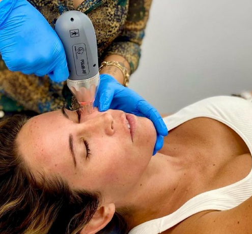 The Need to Know on Radiofrequency Microneedling