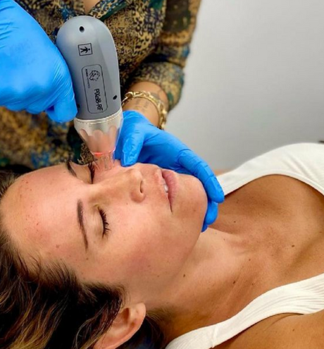 The Need to Know on Radiofrequency Microneedling