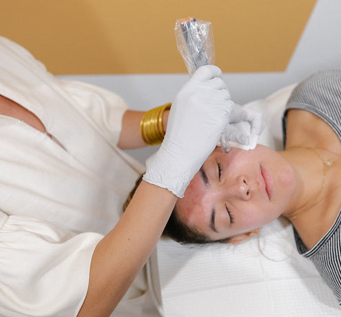 Radiofrequency Microneedling or Morpheus 8 -  Is There a Difference?