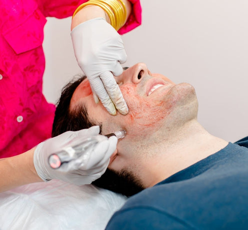 The Microneedling Rundown With Before and After Photos