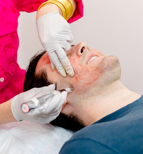 The Microneedling Rundown With Before and After Photos