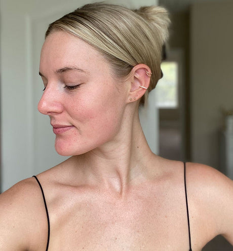 Tackling Melasma on the Face