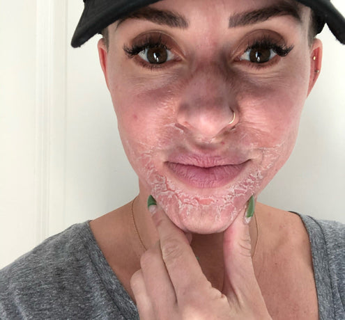 What to Do After a Chemical Peel: Dr. Zoe's Aftercare Must-Haves and Tips