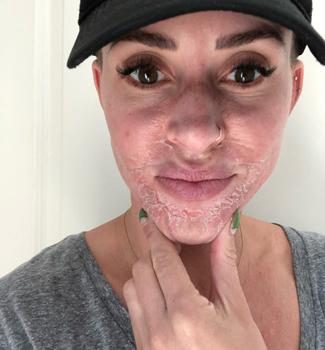 What to Do After a Chemical Peel: Dr. Zoe's Aftercare Must-Haves and Tips