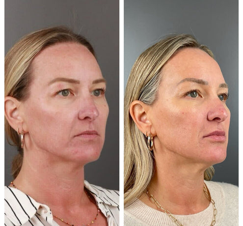 Client Case Study: Filler Rejuvenation for Volume Loss