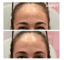 Client Case Study: Jordan with Melasma