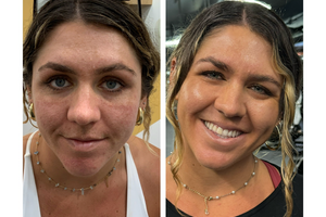 Client Case Study: Vanessa with Lasting Effects of Acne