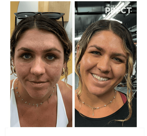 Client Case Study: Vanessa with Lasting Effects of Acne