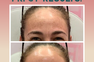 No Treatments, No Filters: Just PRFCTSKIN Results