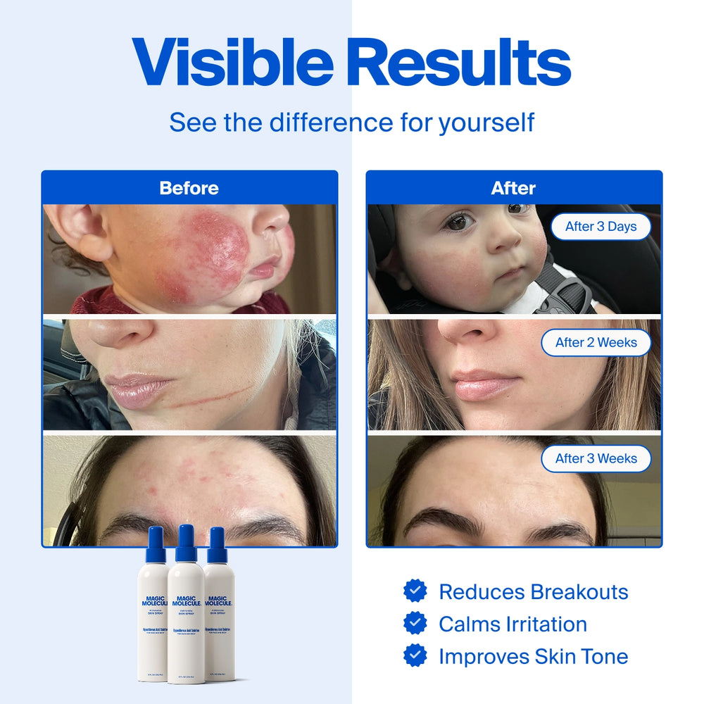 Magic Molecule The Solution - Hypochlorous Acid Skin Spray - View 2