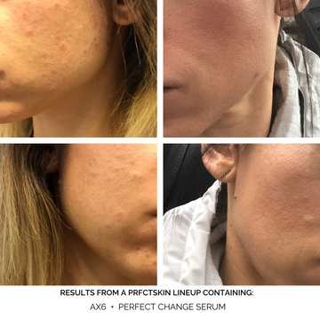 Advanced X6: Exfoliating & Brightening Pads – PRFCT