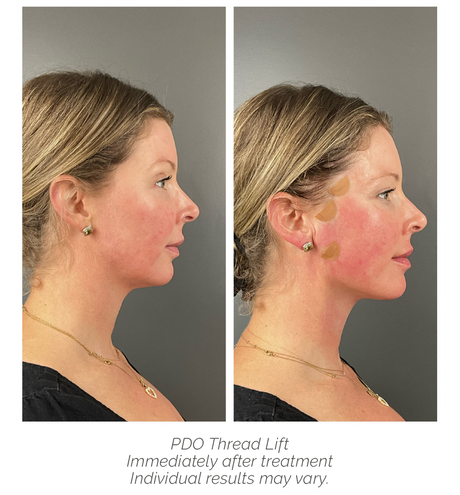 The Post-Weight Loss Glow-Up Guide: Improving Sagging Skin & Facial Hollowing