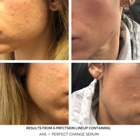 Get Clear Acne Lineup