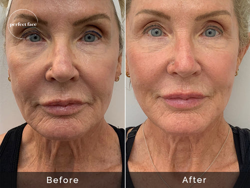 Before & After Gallery | PRFCT, La Jolla