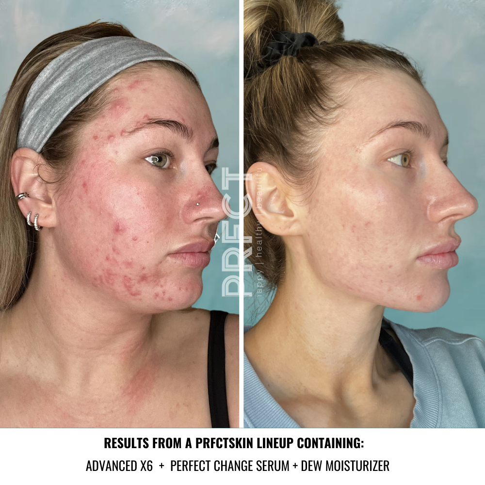 Get Clear Acne Lineup - View 2