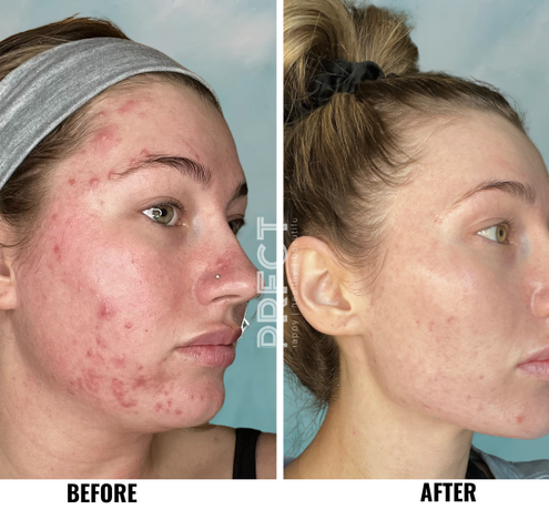 No Treatments, No Filters: Just PRFCTSKIN Results