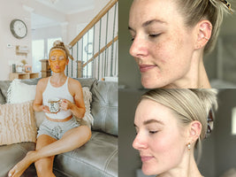 Tackling Melasma on the Face