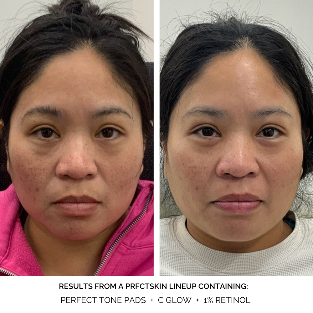 Perfect Tone Pads: Discoloration Fading + Brightening Pads with Kojic Acid | Alpha-Arbutin - View 4