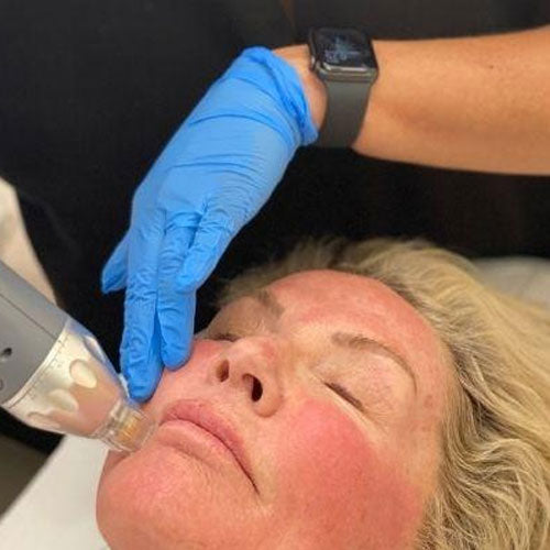 Radiofrequency Microneedling