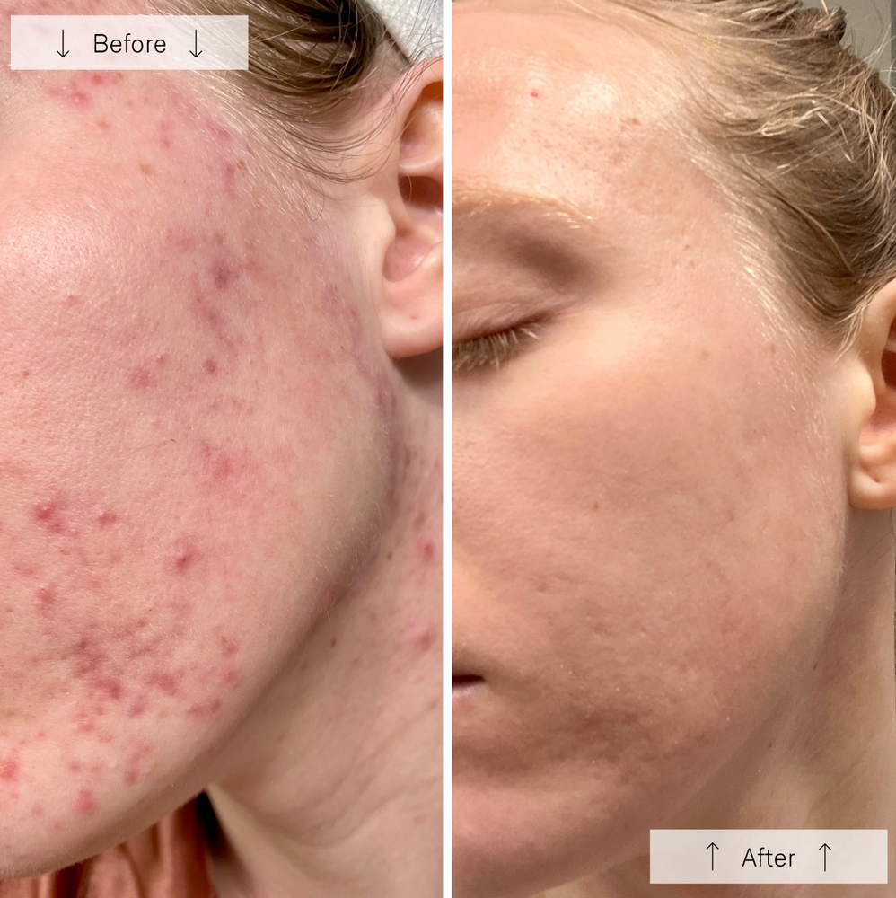 Omnilux Clear LED Light Therapy for Acne - View 3