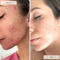 Omnilux Clear LED light therapy mask for treating mild to moderate acne at home