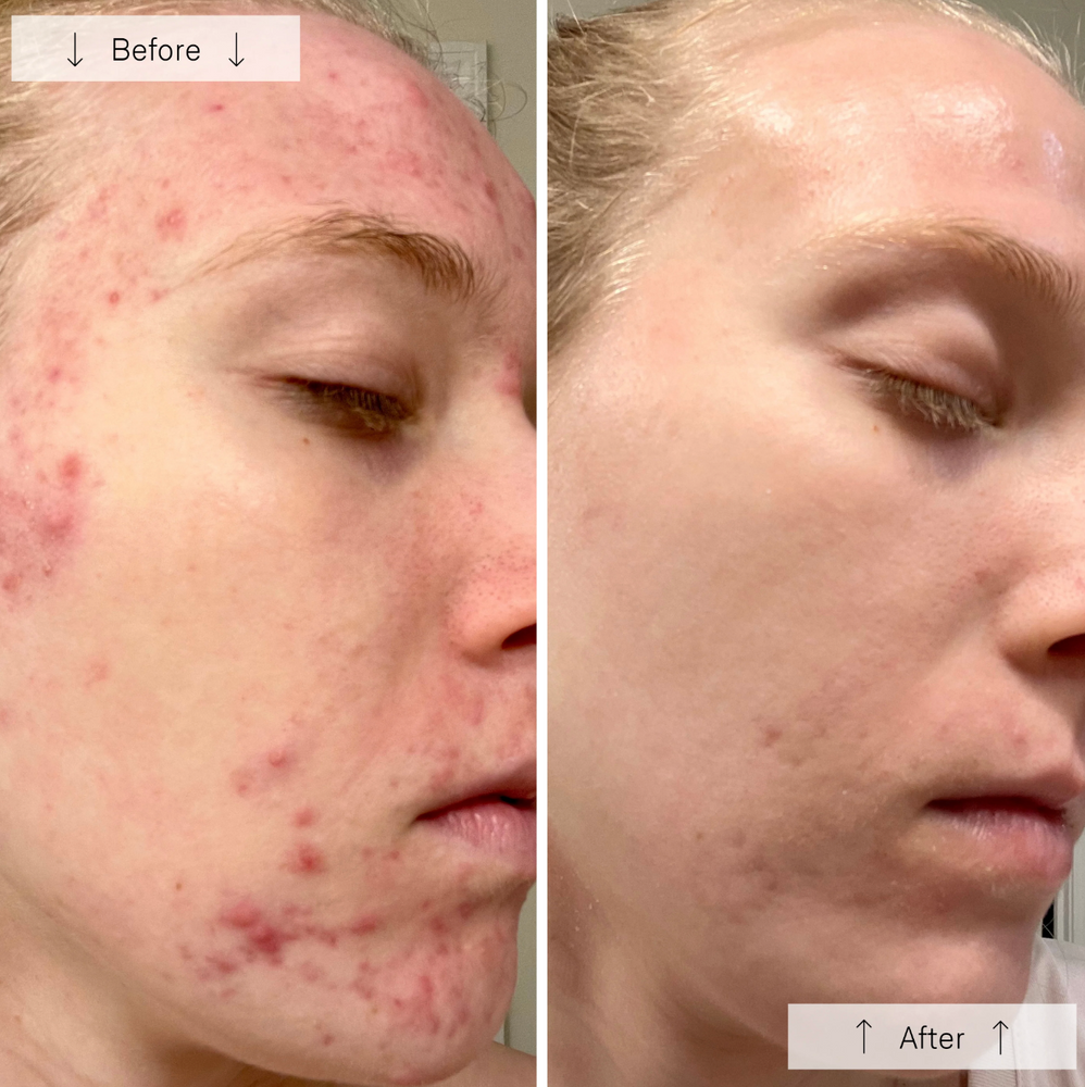 Omnilux Clear LED Light Therapy for Acne - View 6