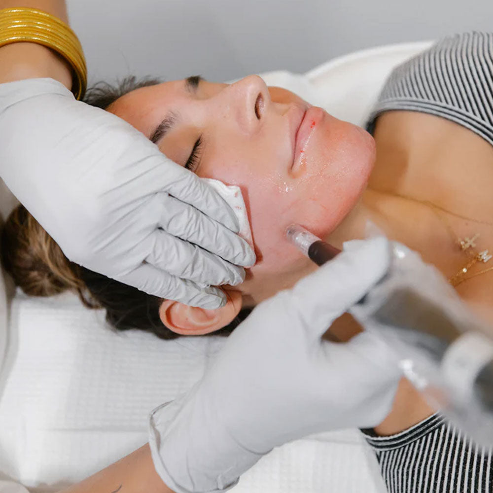 Microneedling 