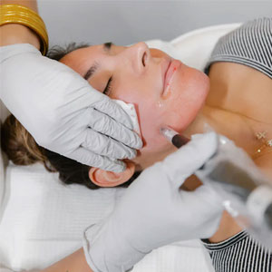 VI Chemical Peels