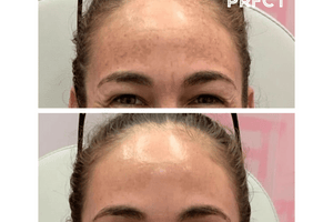 Client Case Study: Jordan with Melasma