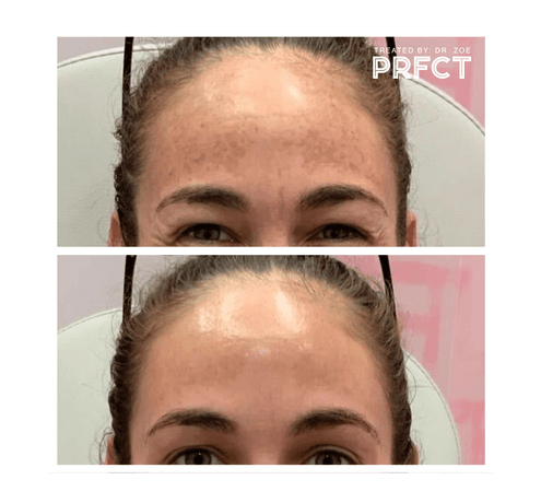 Client Case Study: Jordan with Melasma